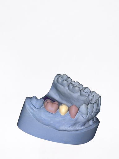 DentalCAD - Modulo Provvisori Flex